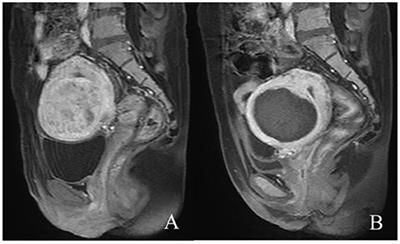 Frontiers A Prediction Of Npvr Of Ultrasound Guided High